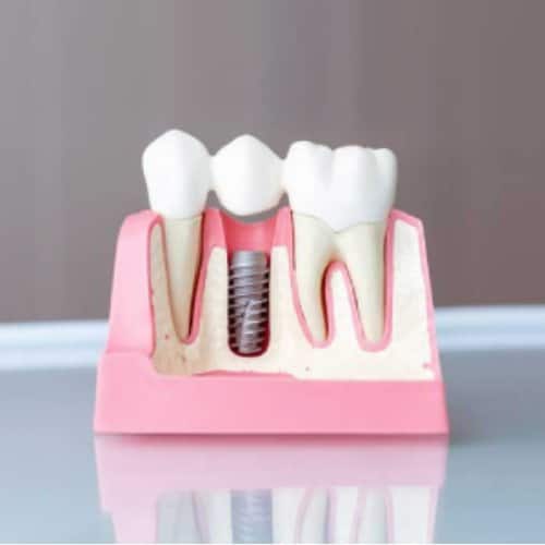 dental implants