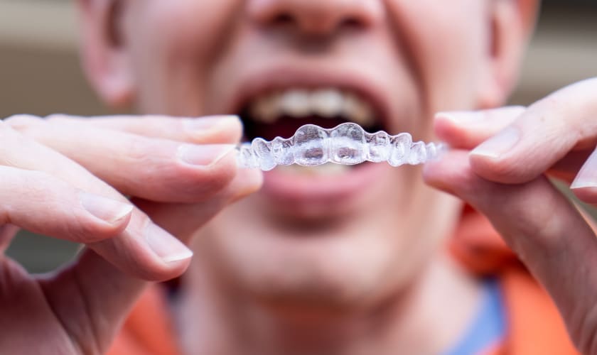 Invisalign Treatment in Mcmurray