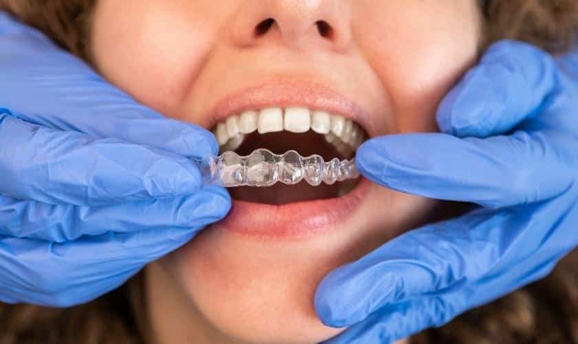 How Invisalign Works