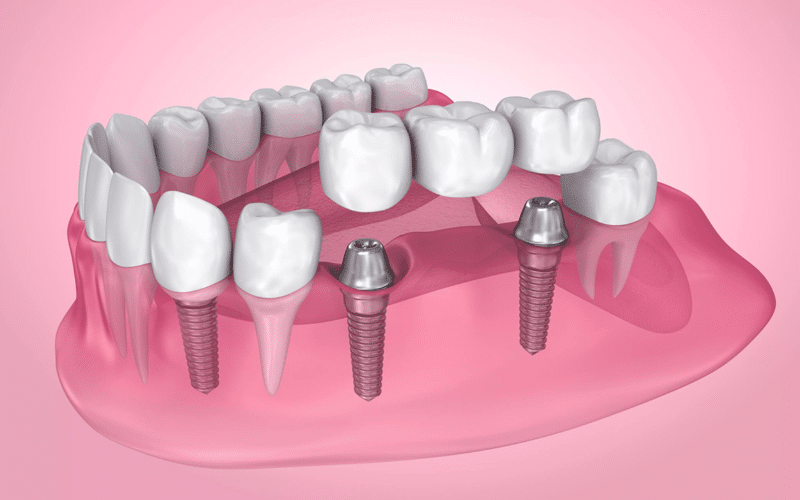types of dental bridges