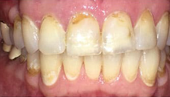 before tooth discoloration  treatment