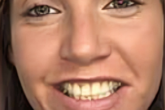 before smile makeover