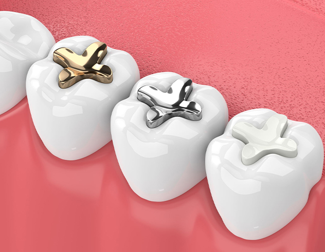 Composite Fillings