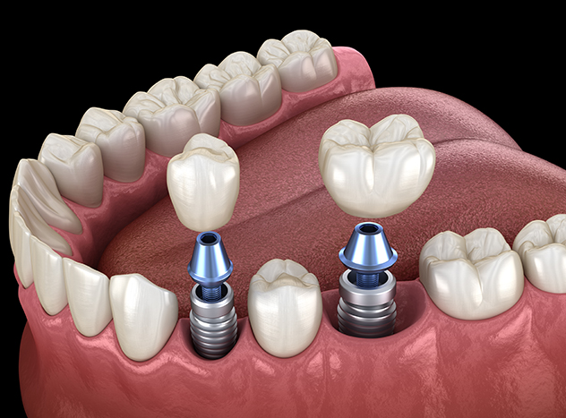 Dental Implants McMurray