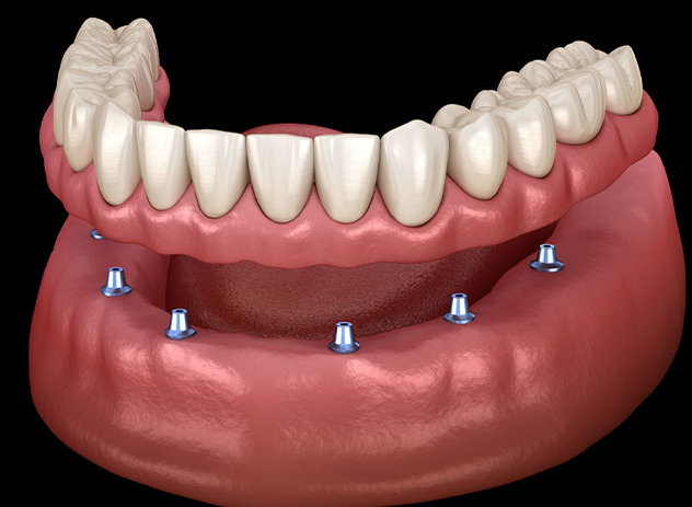 Full-Arch Implant Restorations McMurray