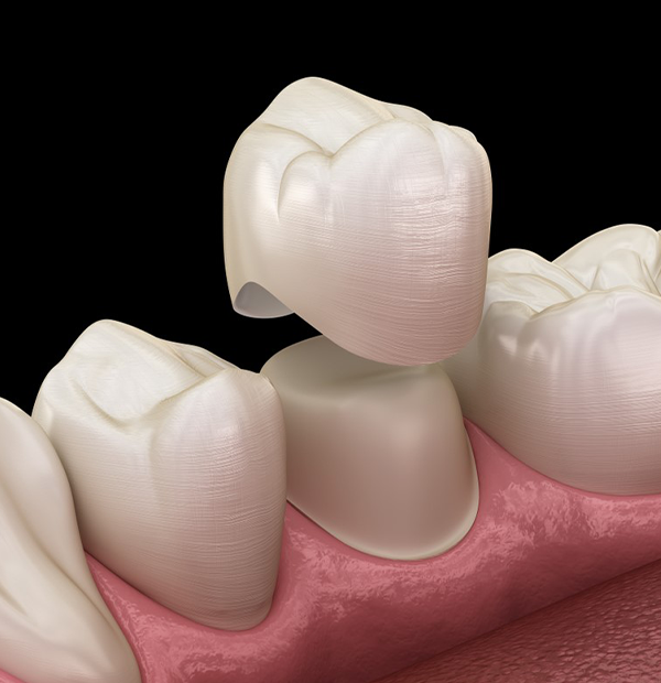 Porcelain Crowns McMurray 