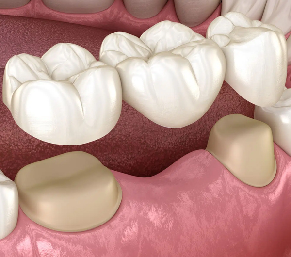 Porcelain Bridges McMurray 