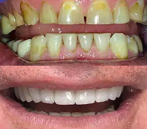 patients teeth during treatment