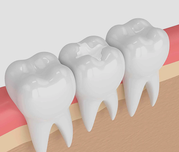 White Fillings McMurray