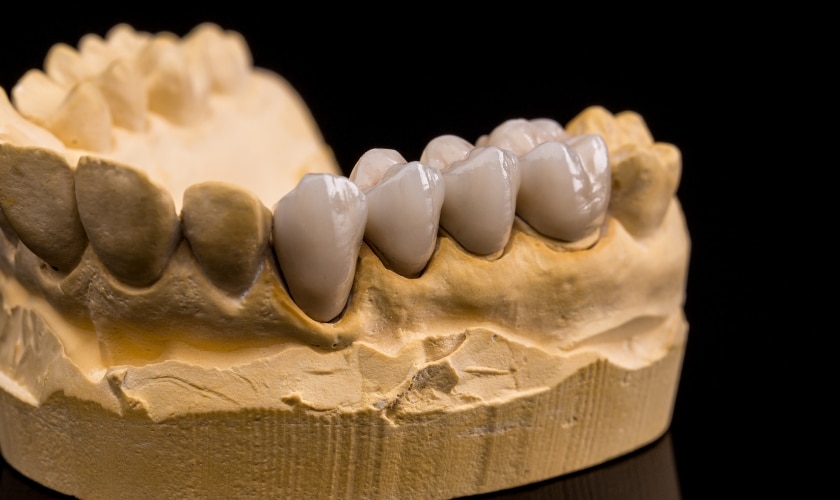 how long do porcelain bridges last