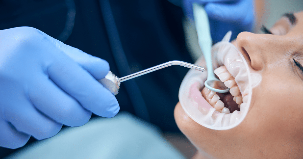 Can White Fillings Fix Cracked Teeth A Complete Guide