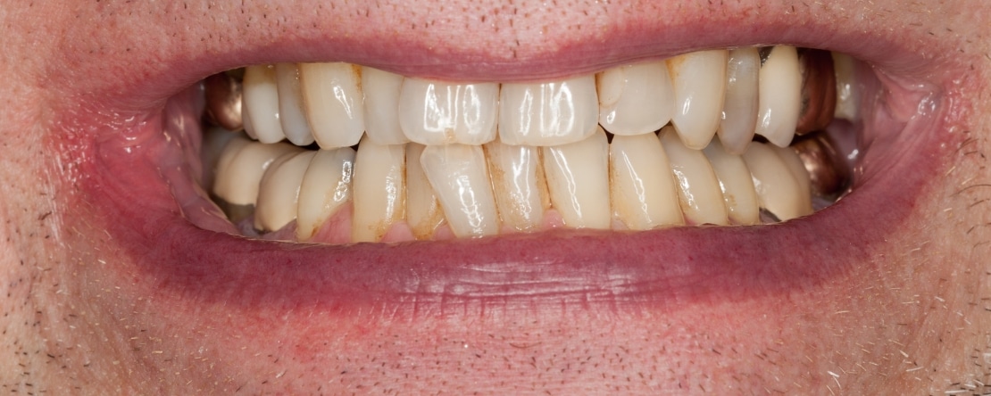 what causes tooth discoloration