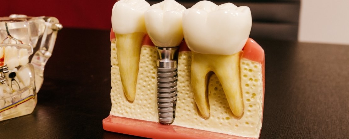 how you can get implants years after tooth extraction