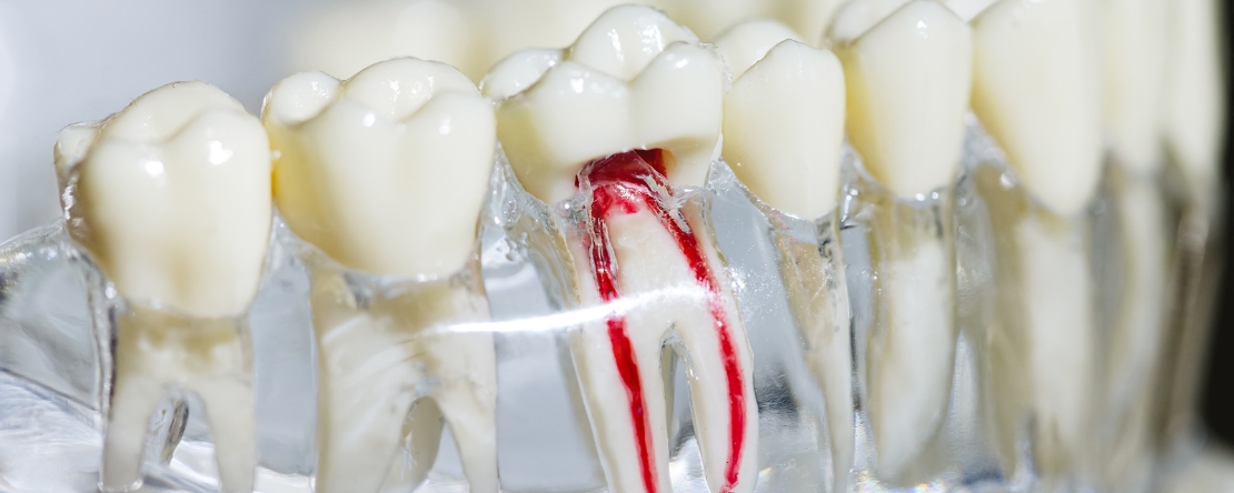 the foods you can eat and avoid post-root canal treatment