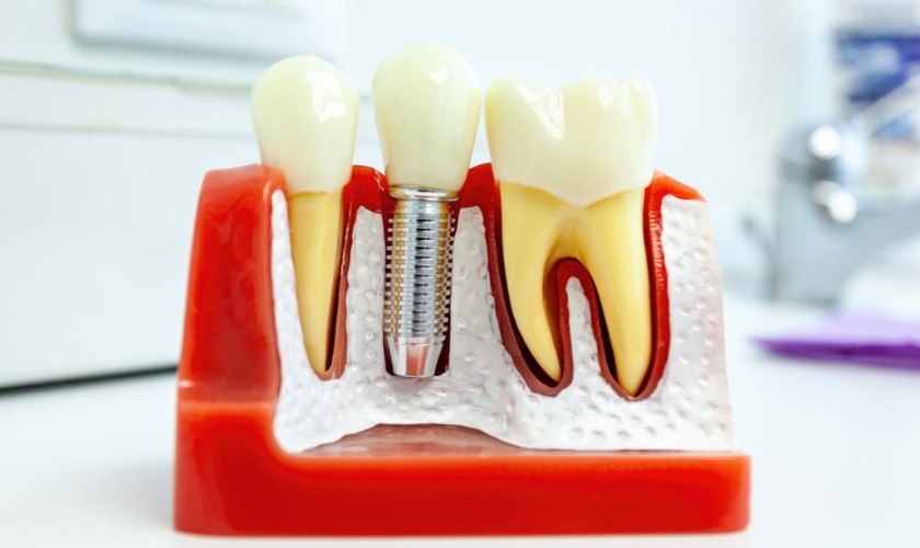 dental implants in McMurray